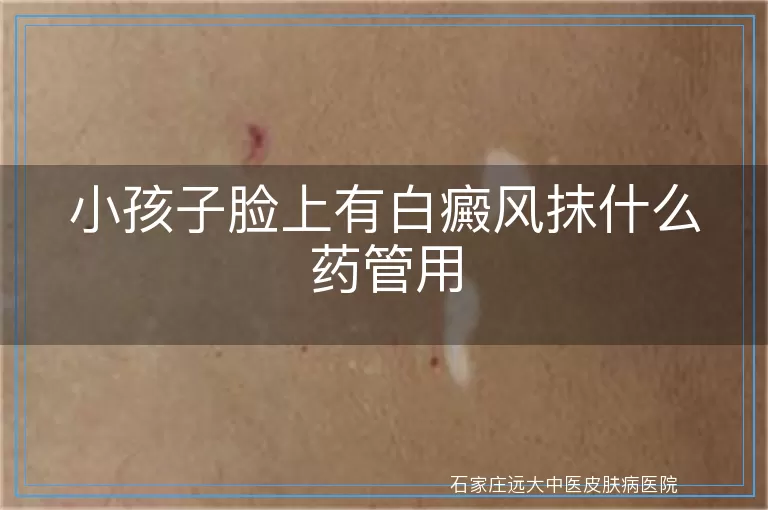 小孩子脸上有白癜风抹什么药管用