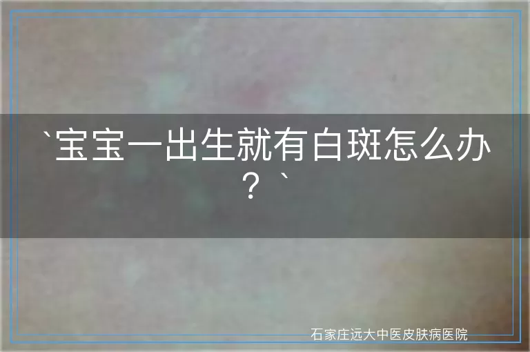 宝宝一出生就有白斑怎么办？