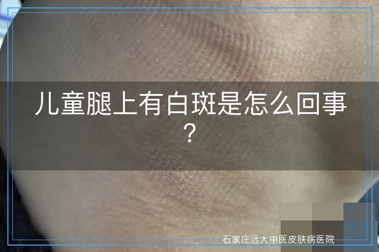 儿童腿上有白斑是怎么回事？