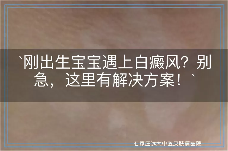 刚出生宝宝遇上白癜风？别急，这里有解决方案！