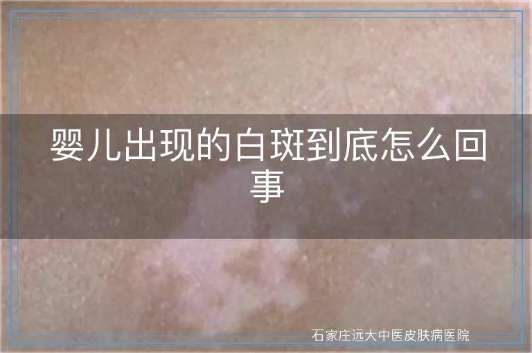 婴儿出现的白斑到底怎么回事