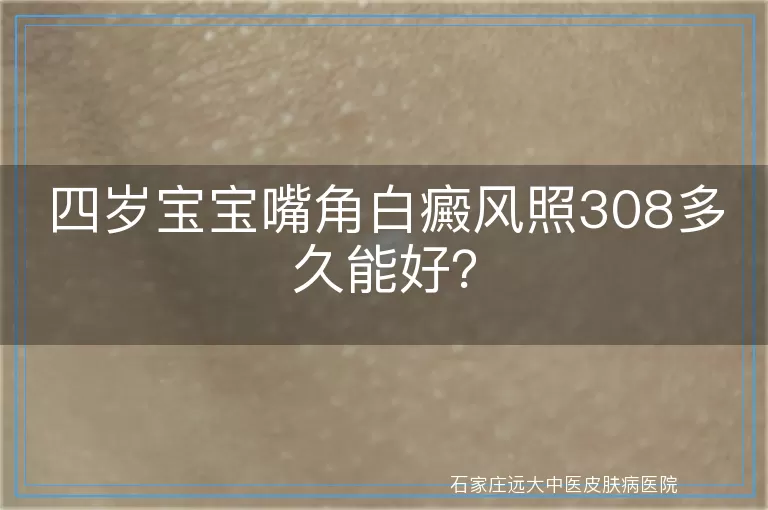 四岁宝宝嘴角白癜风照308多久能好？