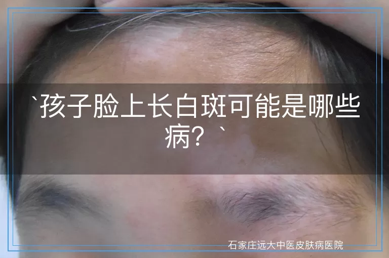 孩子脸上长白斑可能是哪些病？