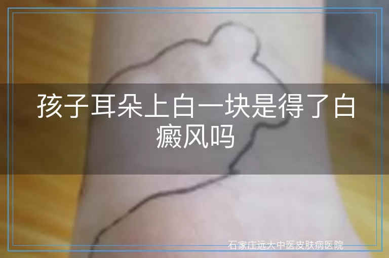 孩子耳朵上白一块是得了白癜风吗