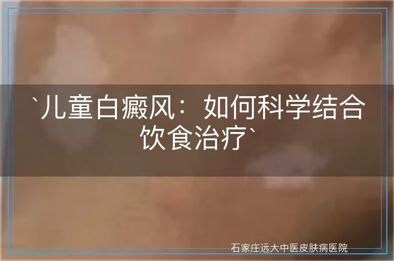 儿童白癜风：如何科学结合饮食治疗