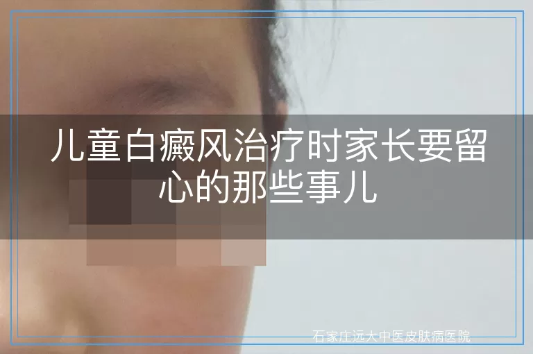 儿童白癜风治疗时家长要留心的那些事儿