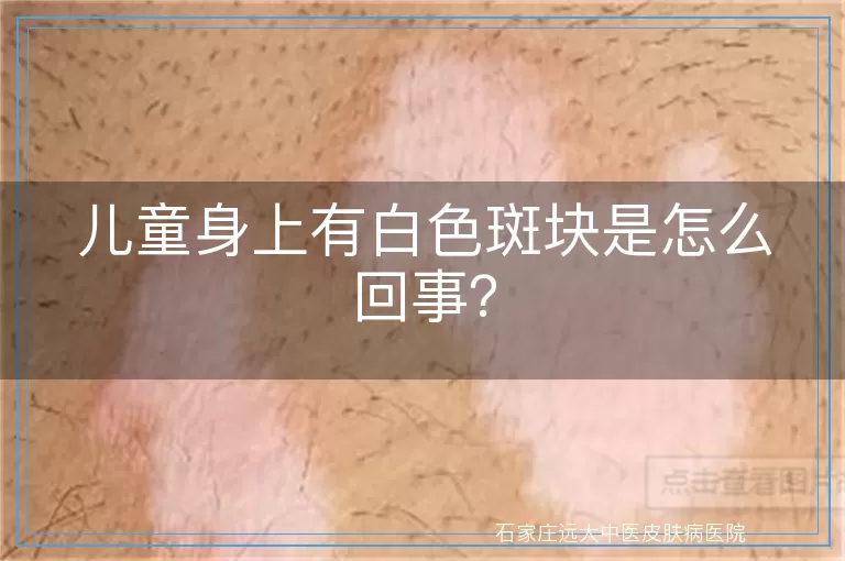 儿童身上有白色斑块是怎么回事？