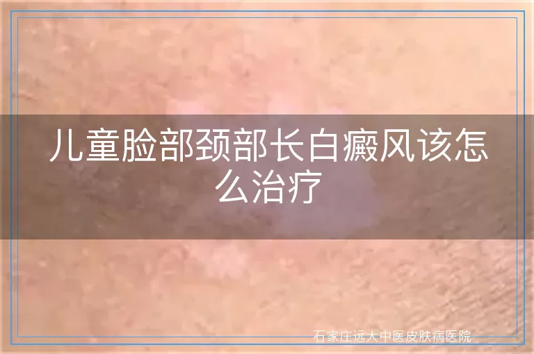 儿童脸部颈部长白癜风该怎么治疗