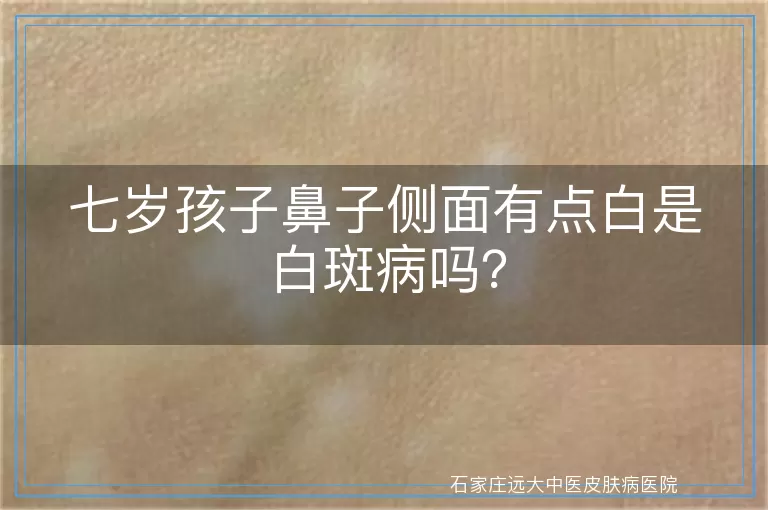 七岁孩子鼻子侧面有点白是白斑病吗？