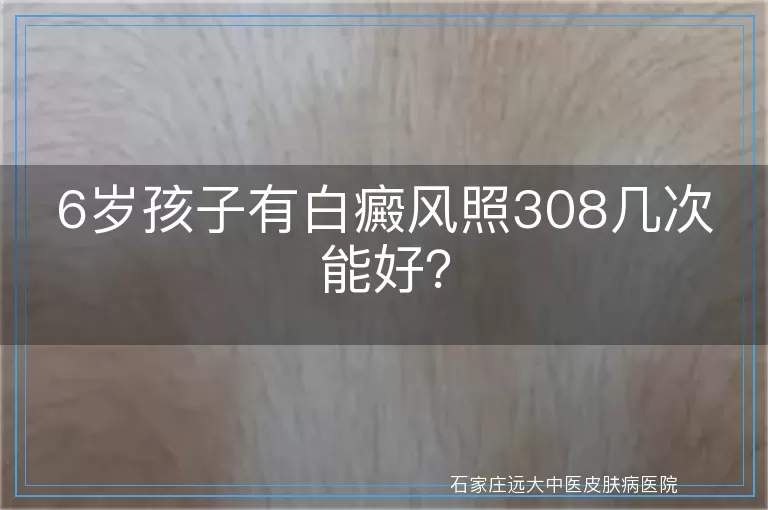 6岁孩子有白癜风照308几次能好？