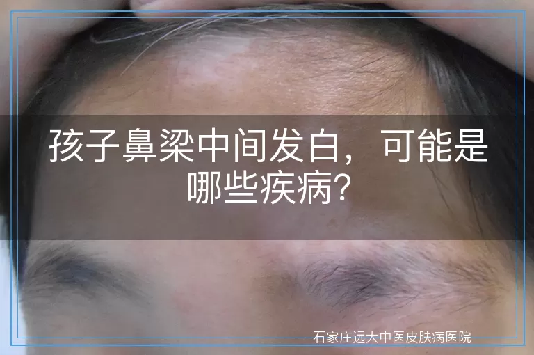 孩子鼻梁中间发白，可能是哪些疾病？