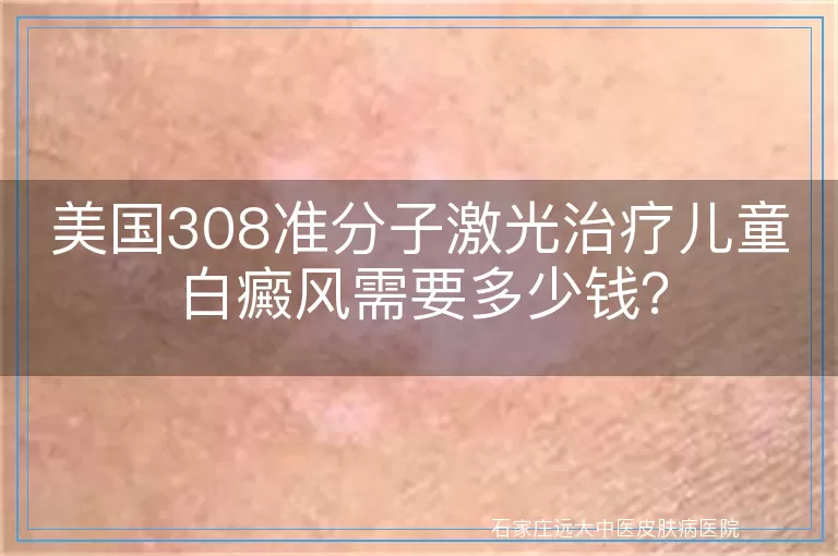 美国308准分子激光治疗儿童白癜风需要多少钱？