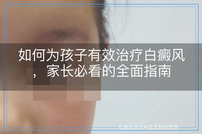 如何为孩子有效治疗白癜风，家长必看的全面指南