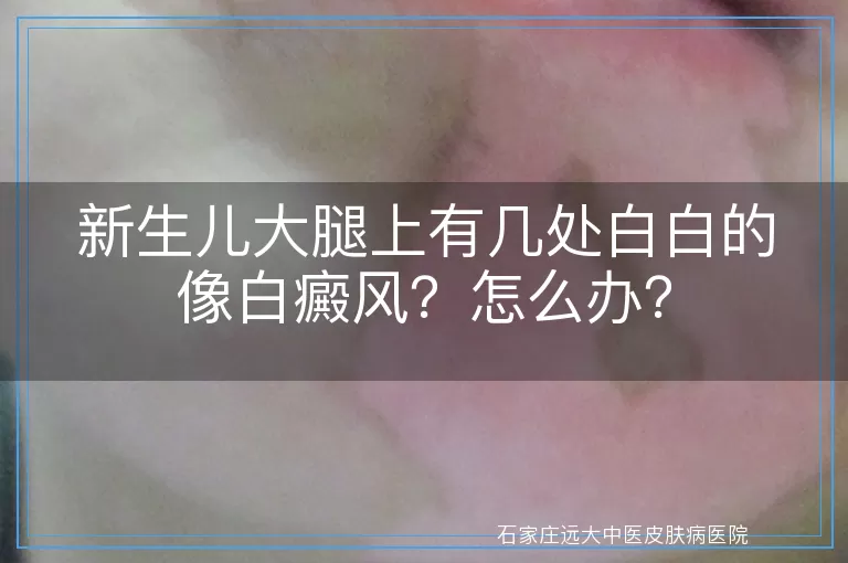 新生儿大腿上有几处白白的像白癜风？怎么办？