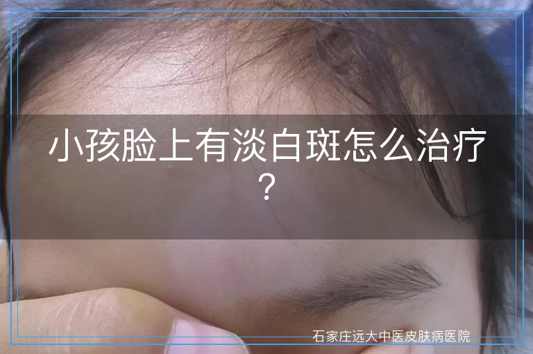 小孩脸上有淡白斑怎么治疗？