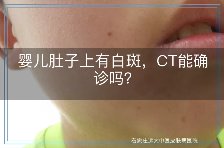 婴儿肚子上有白斑，CT能确诊吗？