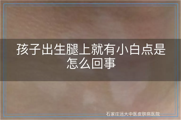 孩子出生腿上就有小白点是怎么回事