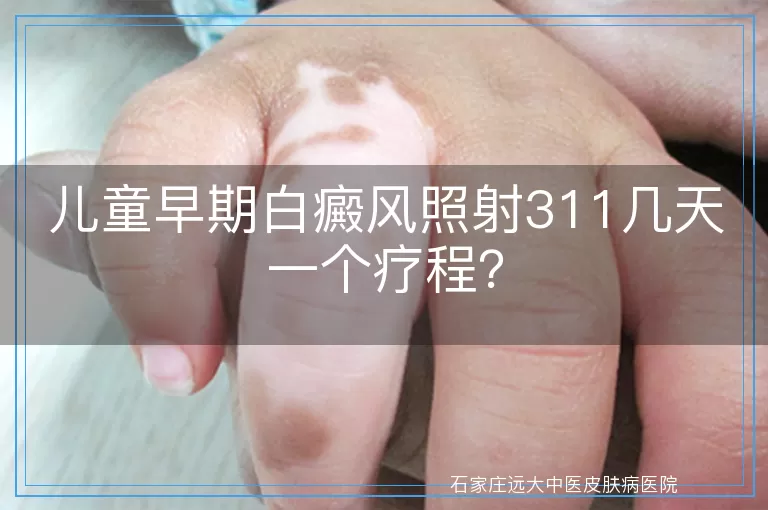 儿童早期白癜风照射311几天一个疗程？