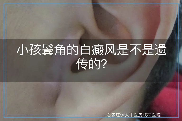 小孩鬓角的白癜风是不是遗传的？