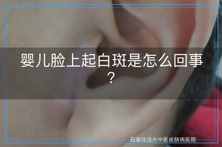 婴儿脸上起白斑是怎么回事？