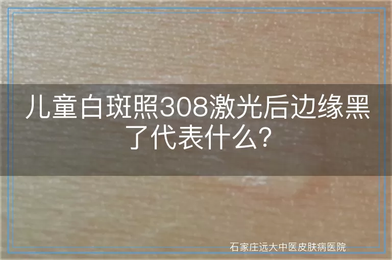 儿童白斑照308激光后边缘黑了代表什么？