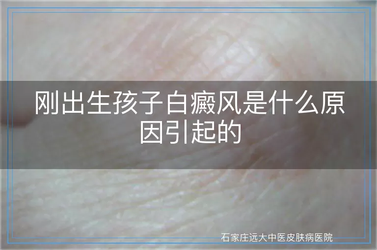 刚出生孩子白癜风是什么原因引起的