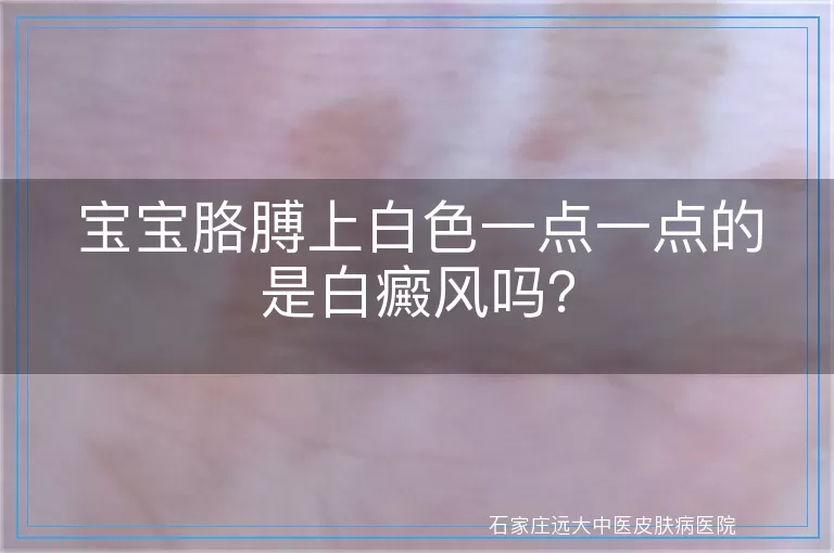 宝宝胳膊上白色一点一点的是白癜风吗？