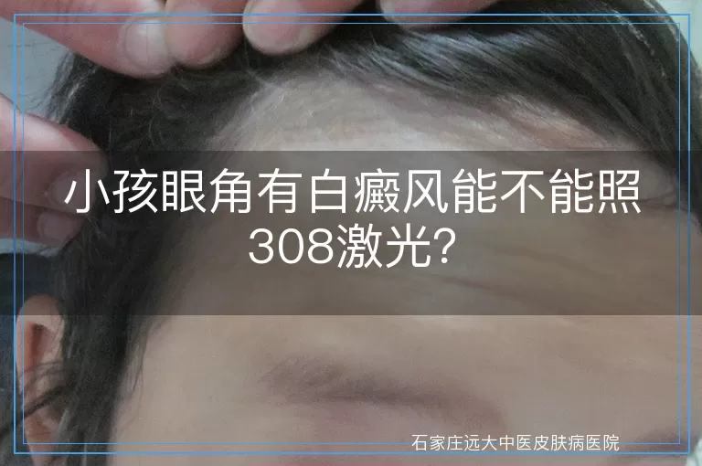 小孩眼角有白癜风能不能照308激光？