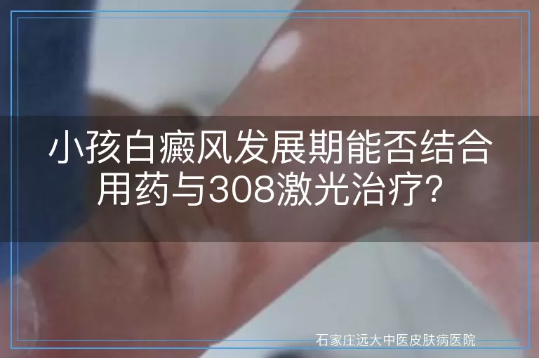 小孩白癜风发展期能否结合用药与308激光治疗？