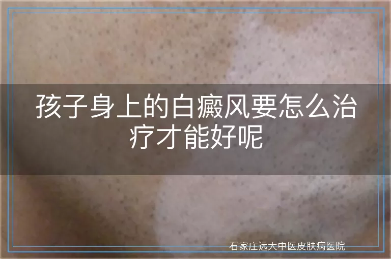 孩子身上的白癜风要怎么治疗才能好呢