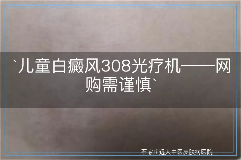 儿童白癜风308光疗机——网购需谨慎