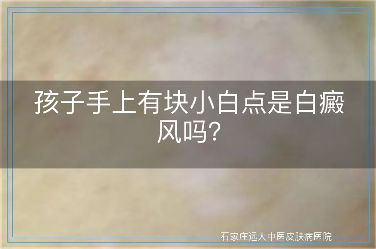 孩子手上有块小白点是白癜风吗？