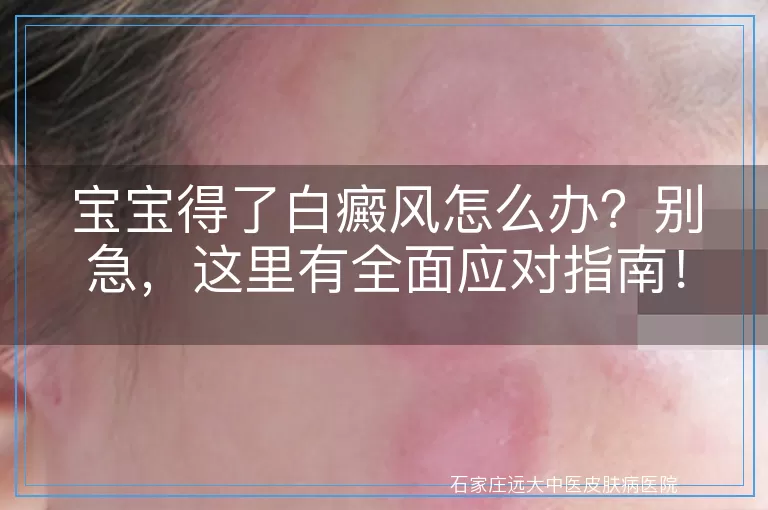 宝宝得了白癜风怎么办？别急，这里有全面应对指南！