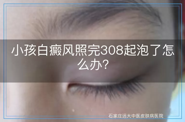 小孩白癜风照完308起泡了怎么办？