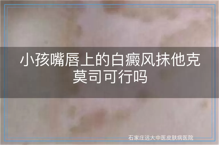 小孩嘴唇上的白癜风抹他克莫司可行吗