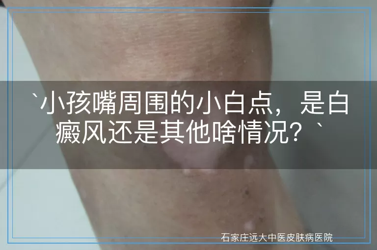 小孩嘴周围的小白点，是白癜风还是其他啥情况？