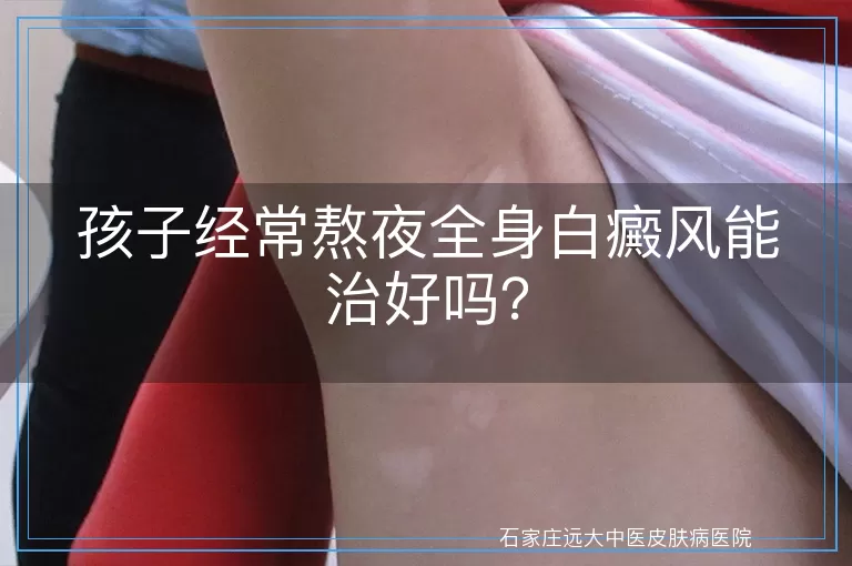 孩子经常熬夜全身白癜风能治好吗？