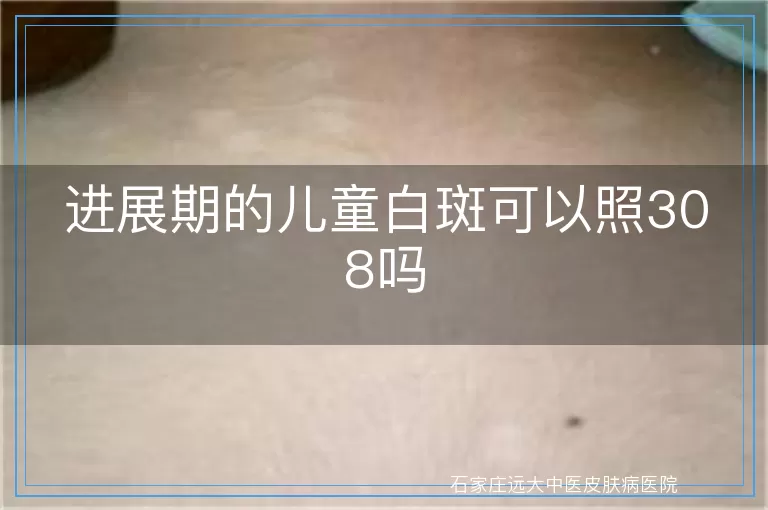 进展期的儿童白斑可以照308吗