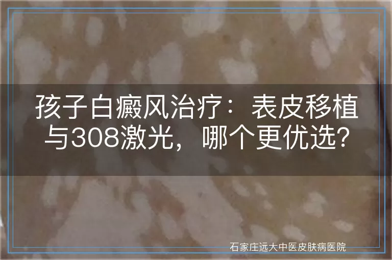 孩子白癜风治疗：表皮移植与308激光，哪个更优选？