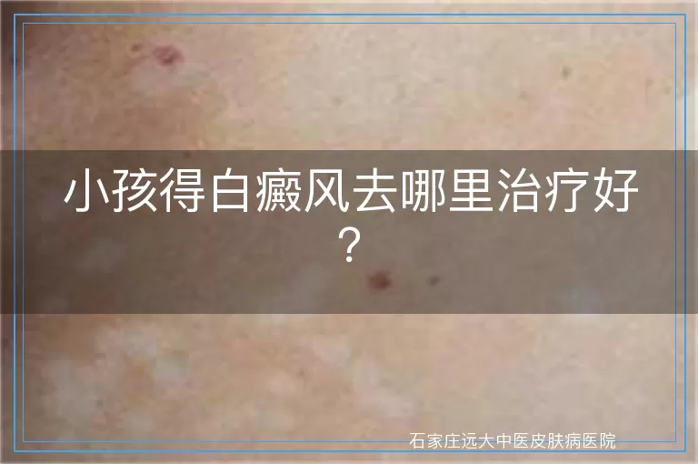 小孩得白癜风去哪里治疗好？