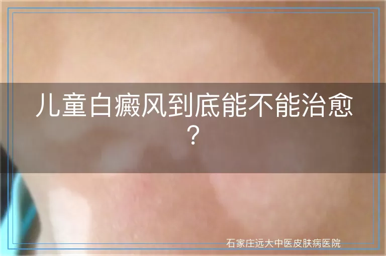 儿童白癜风到底能不能治愈？