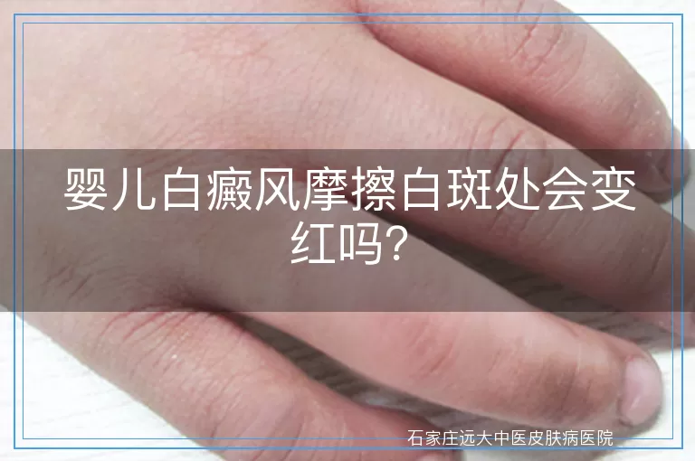 婴儿白癜风摩擦白斑处会变红吗？