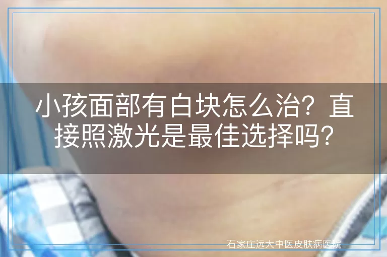 小孩面部有白块怎么治？直接照激光是最佳选择吗？