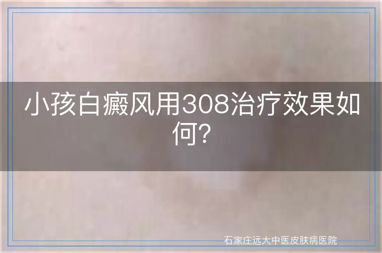 小孩白癜风用308治疗效果如何？