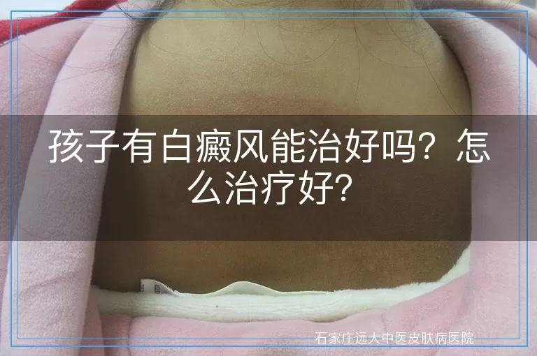 孩子有白癜风能治好吗？怎么治疗好？