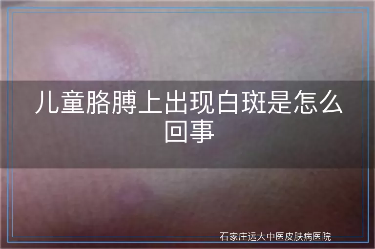 儿童胳膊上出现白斑是怎么回事