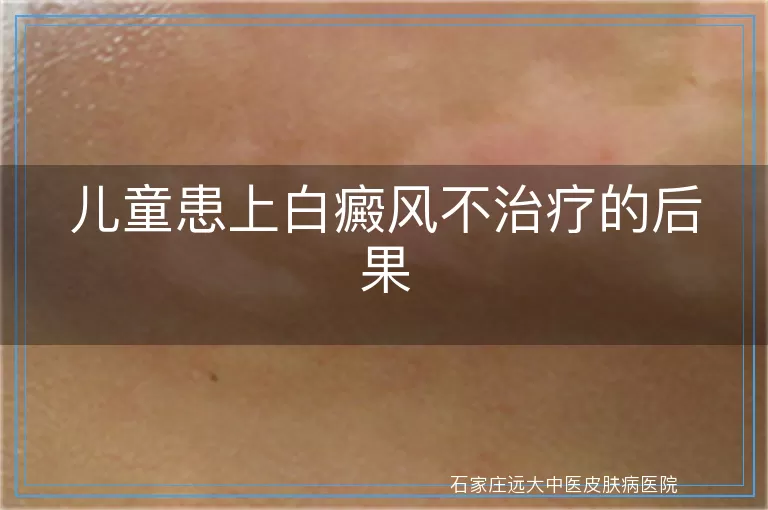 儿童患上白癜风不治疗的后果