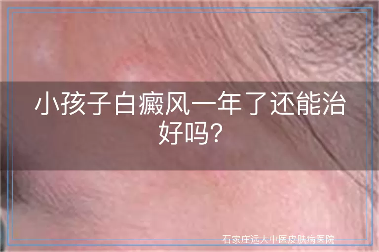 小孩子白癜风一年了还能治好吗？