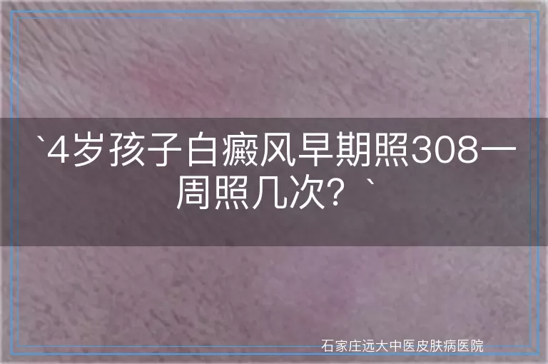 4岁孩子白癜风早期照308一周照几次？