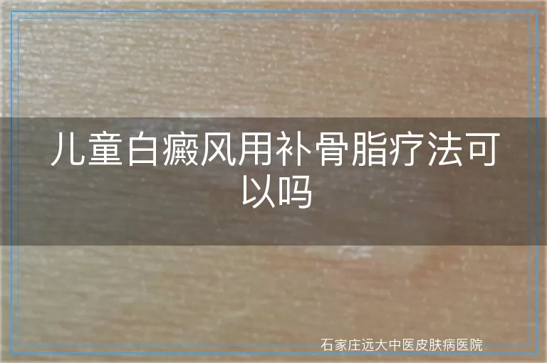 儿童白癜风用补骨脂疗法可以吗